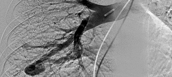 Angiogram